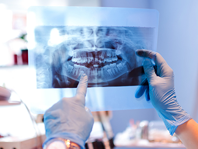Dental Implants Dentist in Grass Valley