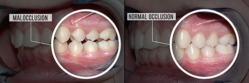 Fore Dental Care | Sports Mouthguards, Dental Sealants and Oral Exams