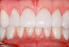 Fore Dental Care | Veneers, Dental Fillings and Intraoral Camera